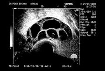 Ultrasound guided transvaginal egg collection. In the picture we can see the tip of the aspiration needle inside the follicle (EUGONIA archive). 